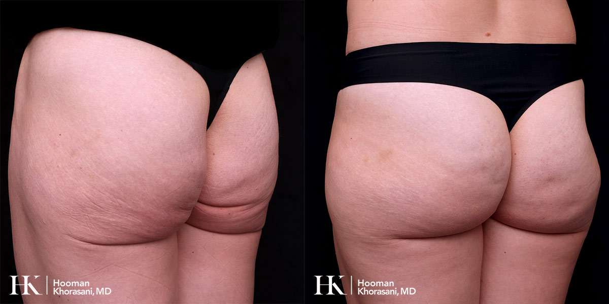 Buttocks Enhancement using Sculpra & Radiesse by Dr. Hooman Khorasani