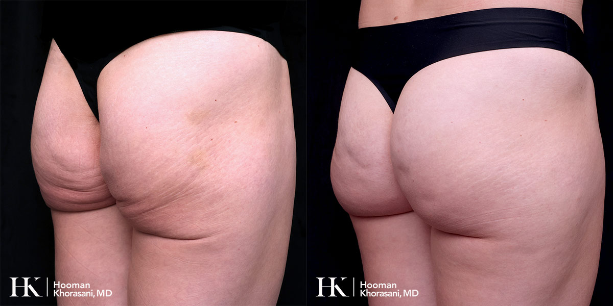 Buttocks Enhancement using Sculpra & Radiesse by Dr. Hooman Khorasani