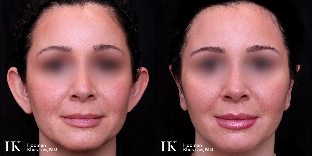 Earlobe Repair using Otoplasty Surgery by Dr. Hooman Khorasani