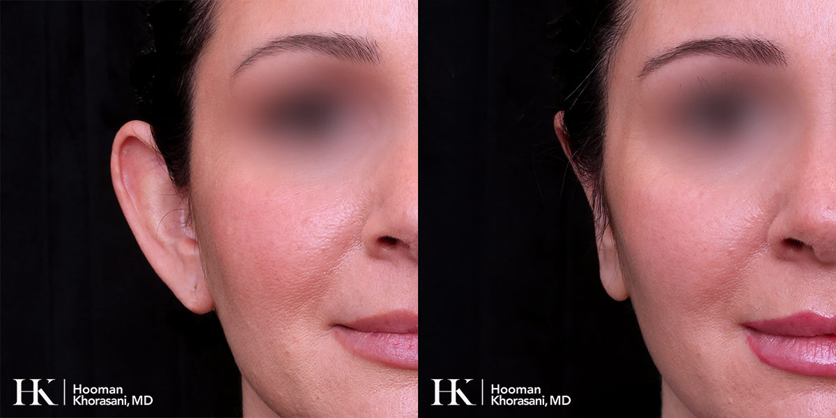 Earlobe Repair using Otoplasty Surgery by Dr. Hooman Khorasani