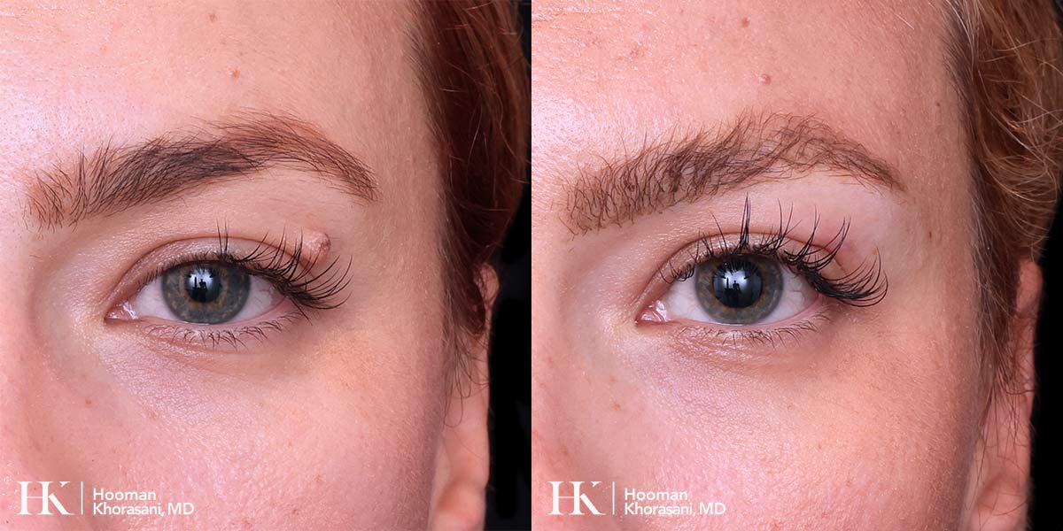 Cosmetic Mole Removal on Eyelid by Excision by Dr. Hooman Khorasani