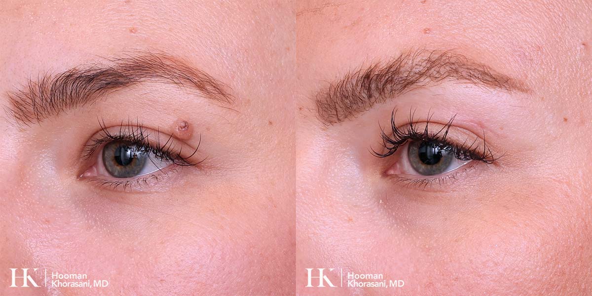 Cosmetic Mole Removal on Eyelid by Excision by Dr. Hooman Khorasani