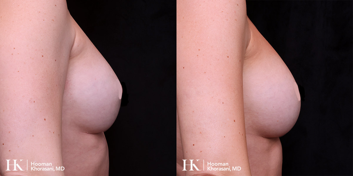 Breast Enhancement by Dr. Hooman Khorasani
