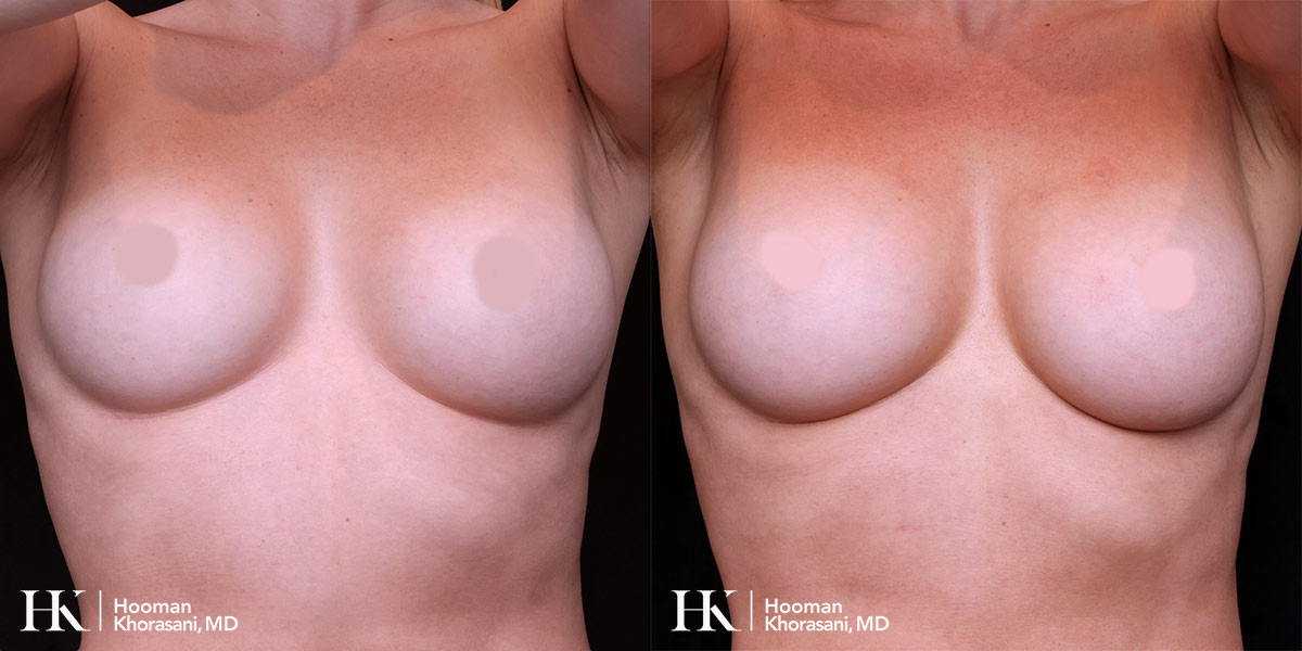 Breast Enhancement by Dr. Hooman Khorasani
