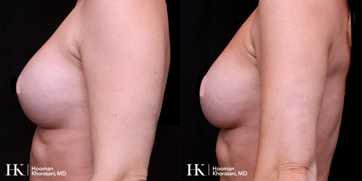 Breast Enhancement by Dr. Hooman Khorasani