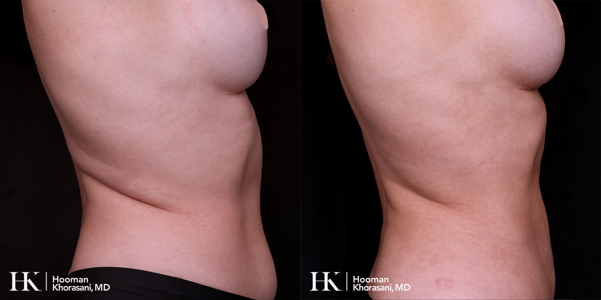 Liposuction of the body and Skin tightening by Dr. Hooman Khorasani