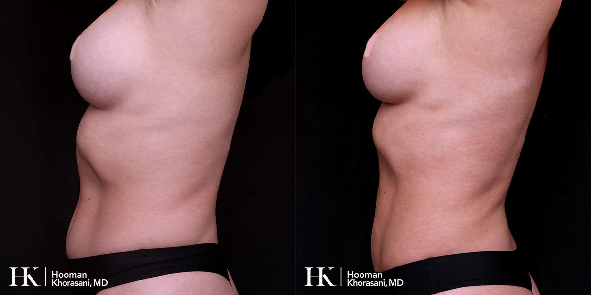 Liposuction of the body and Skin tightening by Dr. Hooman Khorasani