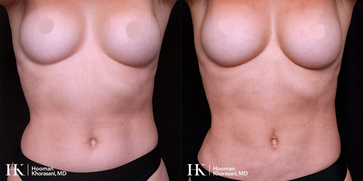 Liposuction of the body by Dr. Hooman Khorasani