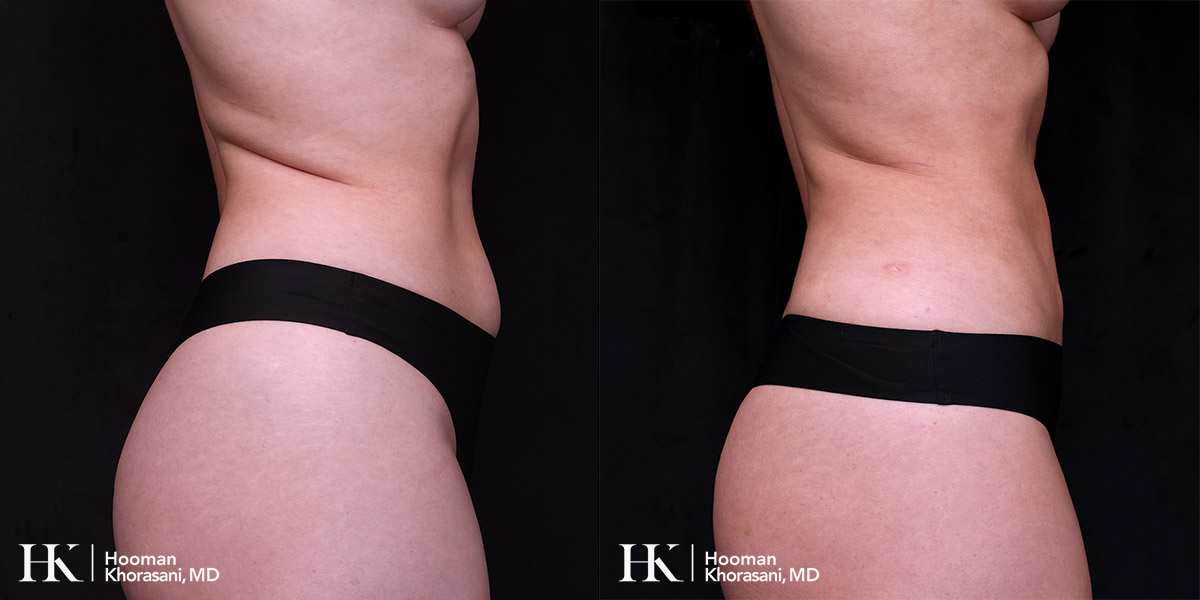 Liposuction of the body and Skin tightening by Dr. Hooman Khorasani