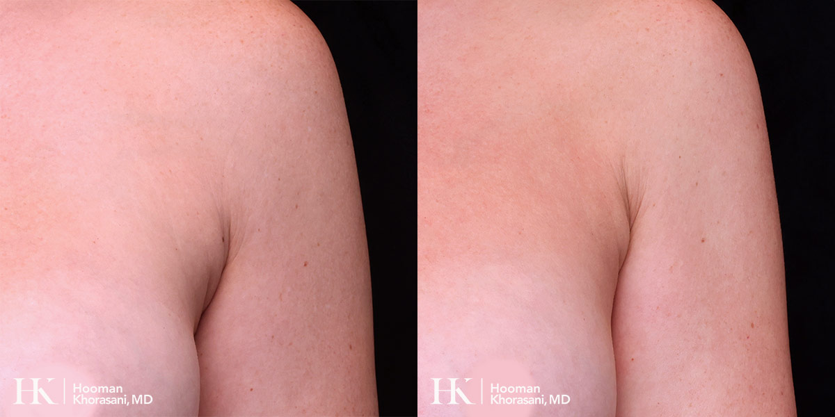Liposuction of the arm pit by Dr. Hooman Khorasani