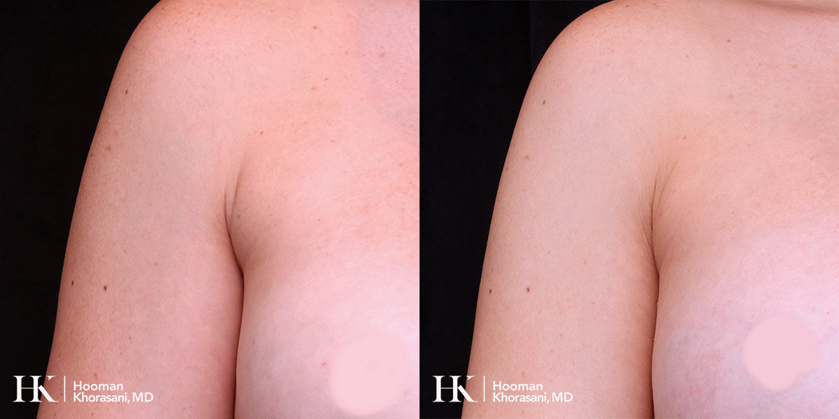 Liposuction of the arm pit by Dr. Hooman Khorasani
