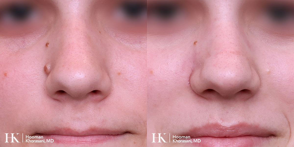 Cosmetic Mole Removal on Eyelid by Excision by Dr. Hooman Khorasani