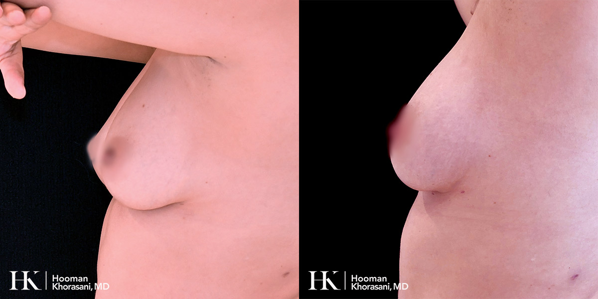 Breast Enhancement by Dr. Hooman Khorasani