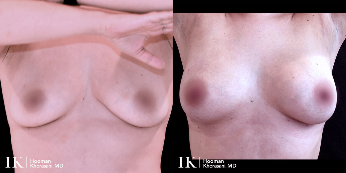 Breast Enhancement by Dr. Hooman KhorasaniBreast Enhancement by Dr. Hooman Khorasani