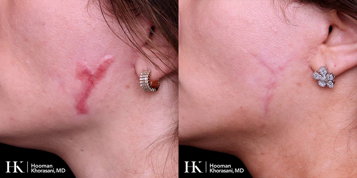Scar Revision using Keloid Excision by Dr. Hooman Khorasani