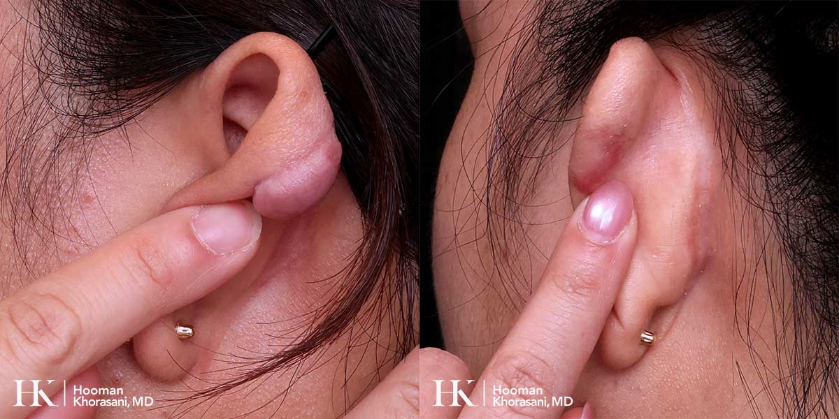 Scar Revision using Keloid Excision by Dr. Hooman Khorasani