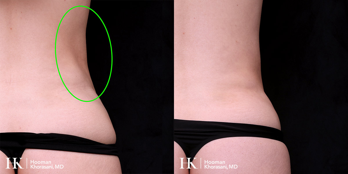 Contour Deformity Correction using Nano Fat Transfer by Dr. Hooman Khorasani