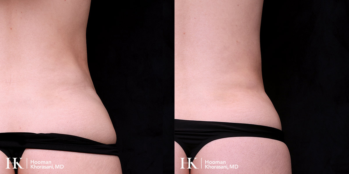 Contour Deformity Correction using Nano Fat Transfer by Dr. Hooman Khorasani