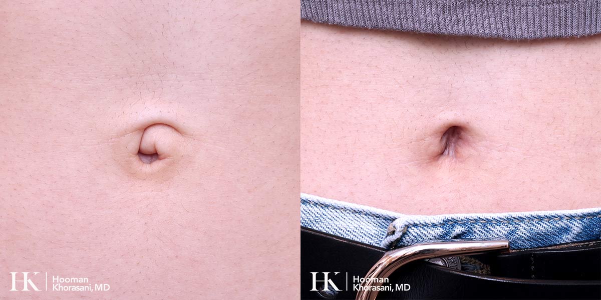 Belly Button Revision by Dr. Hooman Khorasani New York City