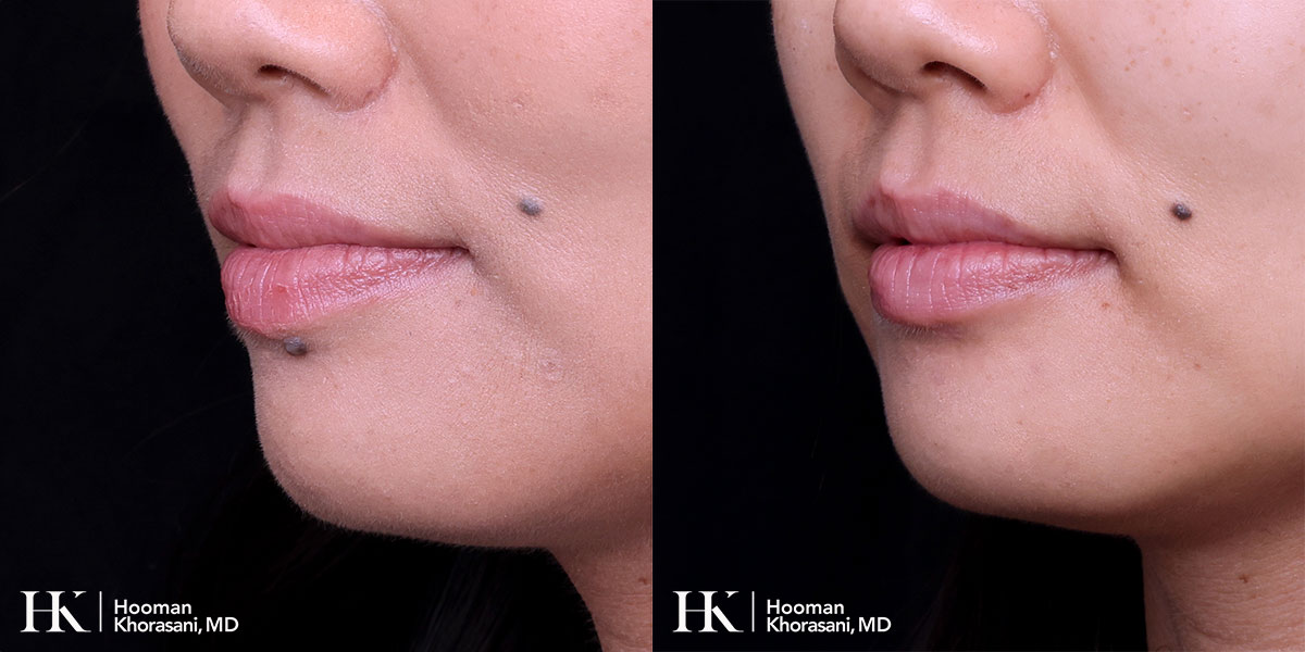 Cosmetic Mole Removal on Eyelid by Excision by Dr. Hooman Khorasani