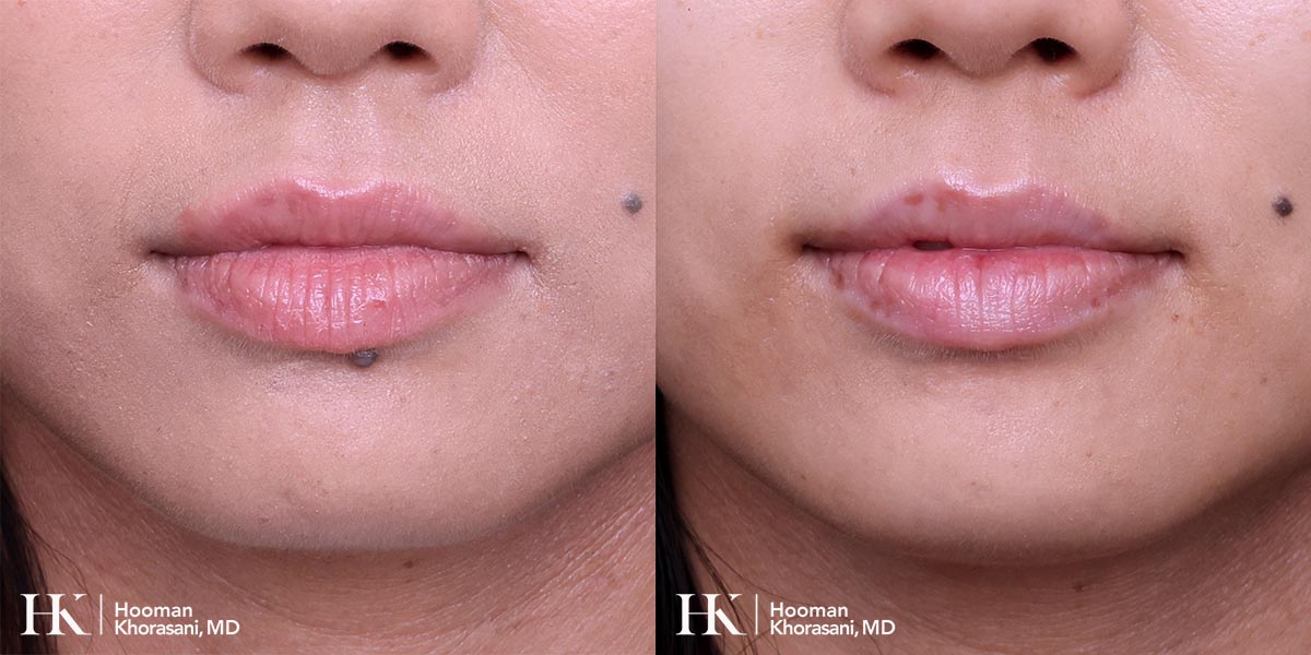 Cosmetic Mole Removal on Eyelid by Excision by Dr. Hooman Khorasani