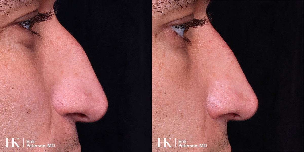 Nose Reshaping (Non-Surgical Rhinoplasty) using Dermal Fillers by Dr. Erik Peterson