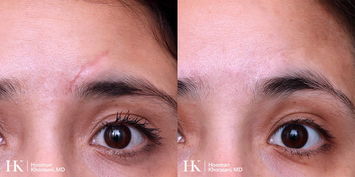 Scar Revision using Keloid Excision by Dr. Hooman Khorasani