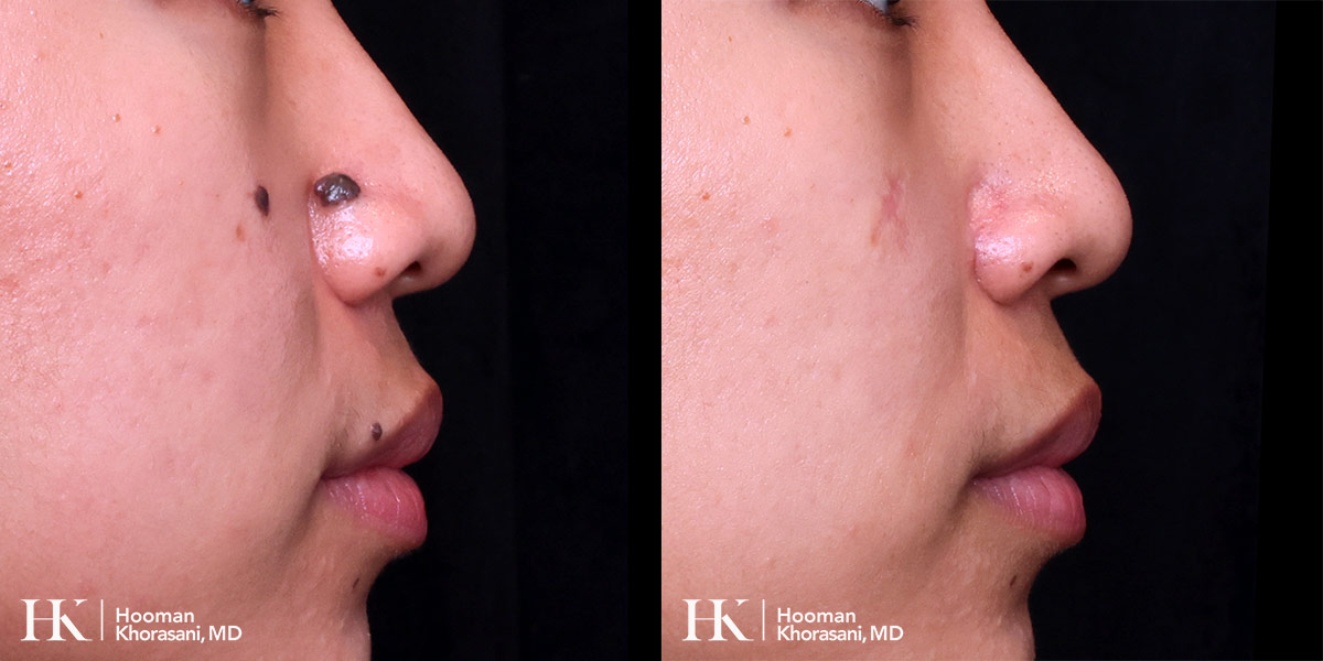 Cosmetic Mole Removal on Eyelid by Excision & PreciseFX Laser by Dr. Hooman Khorasani