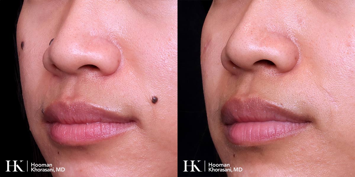Cosmetic Mole Removal on Eyelid by Excision & PreciseFX Laser by Dr. Hooman Khorasani
