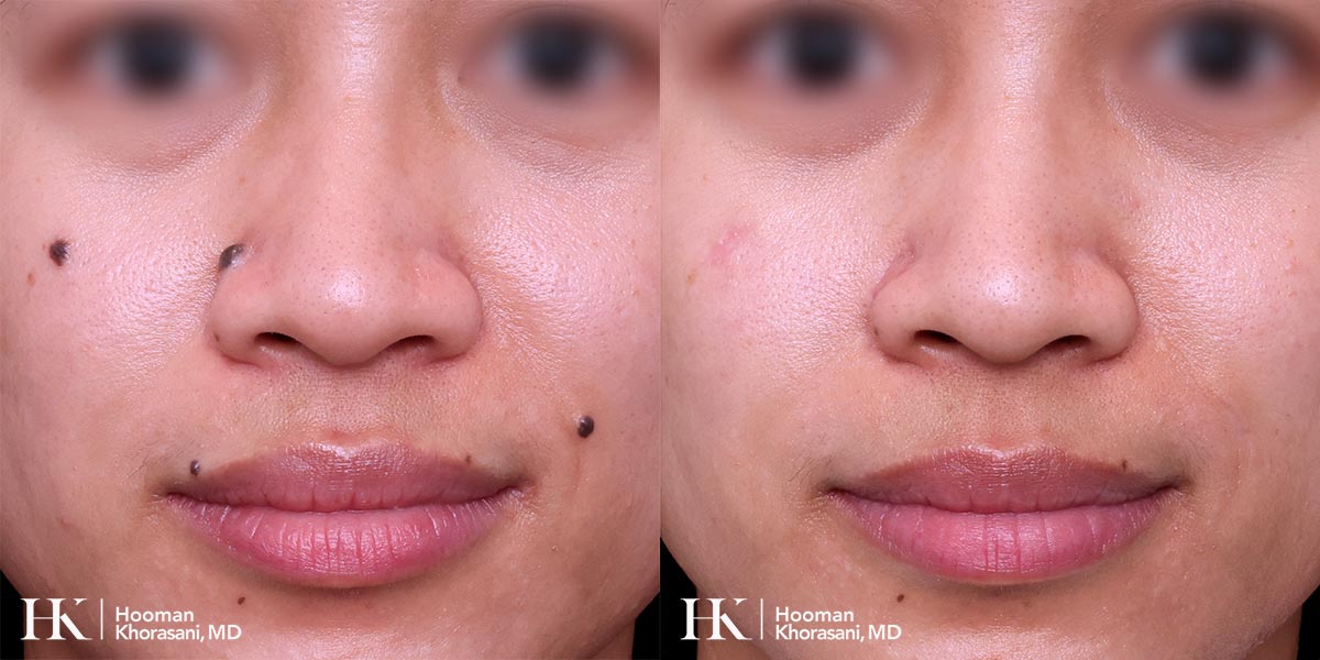 Cosmetic Mole Removal on Eyelid by Excision & PreciseFX Laser by Dr. Hooman Khorasani