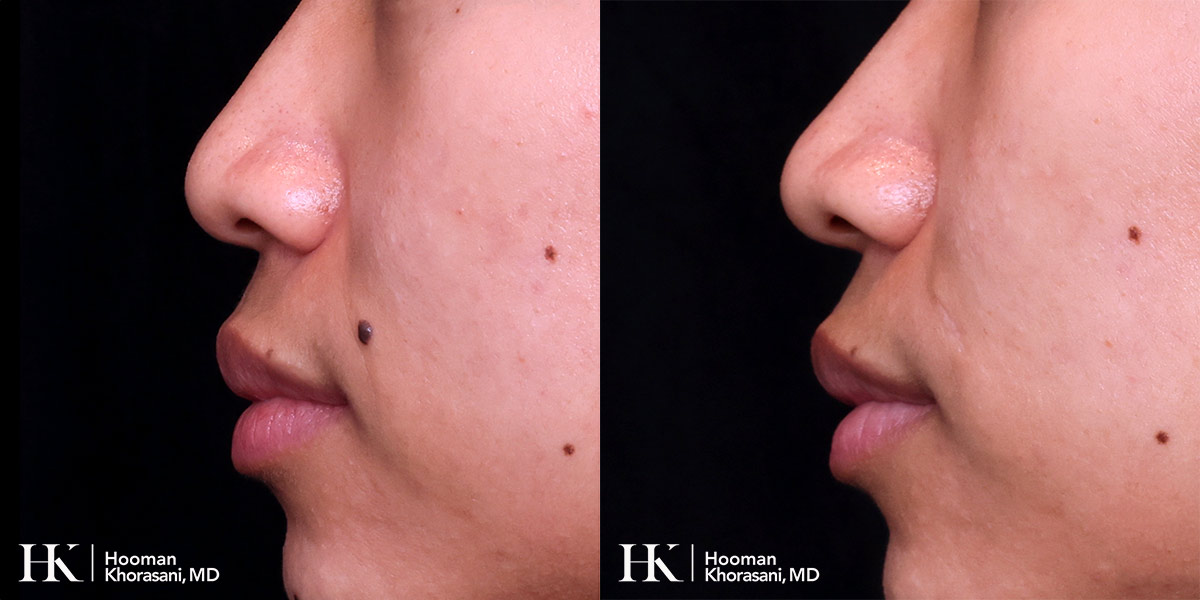 Cosmetic Mole Removal on Eyelid by Excision & PreciseFX Laser by Dr. Hooman Khorasani