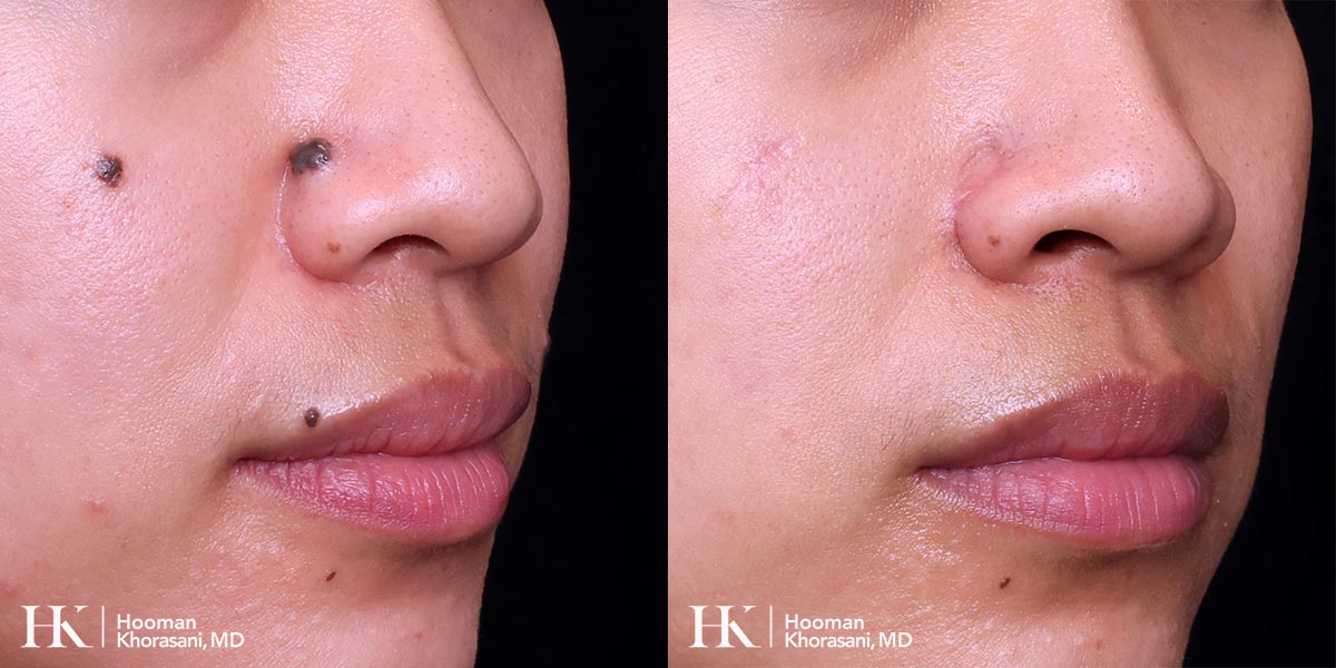 Cosmetic Mole Removal on Eyelid by Excision & PreciseFX Laser by Dr. Hooman Khorasani