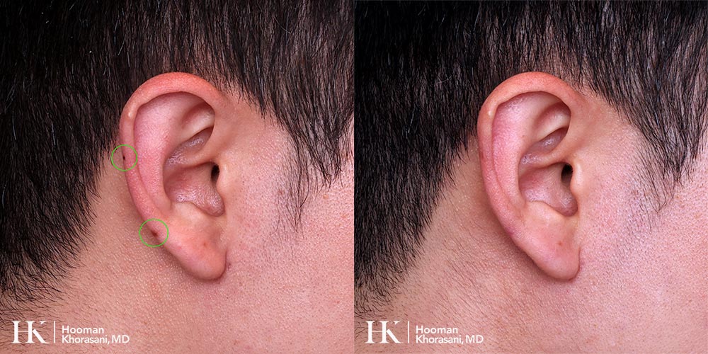 Cosmetic Mole Removal PreciseFX Laser by Dr. Hooman Khorasani