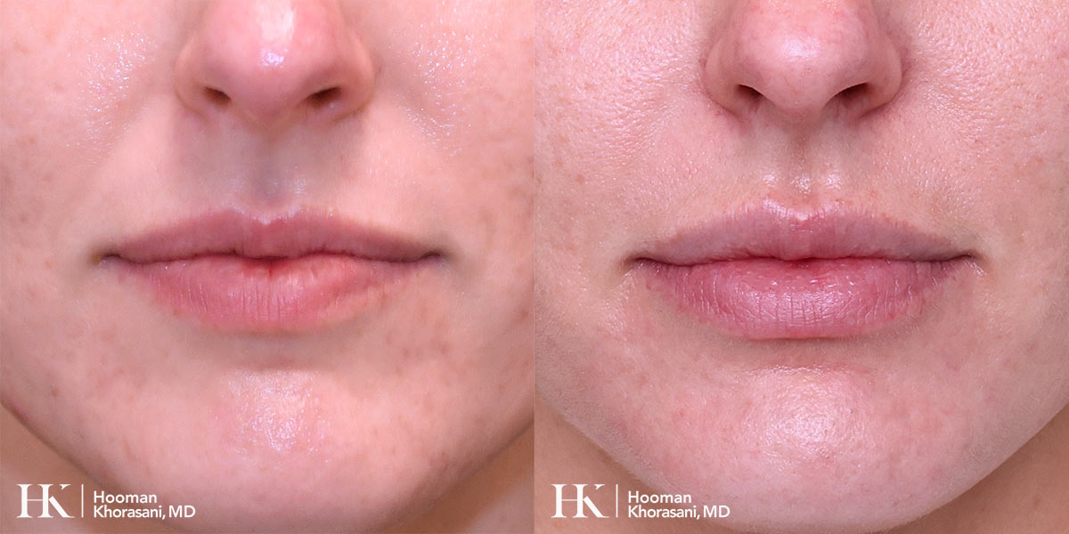 Lip Augmentation using Dermal Filler by Dr. Hooman Khorasani