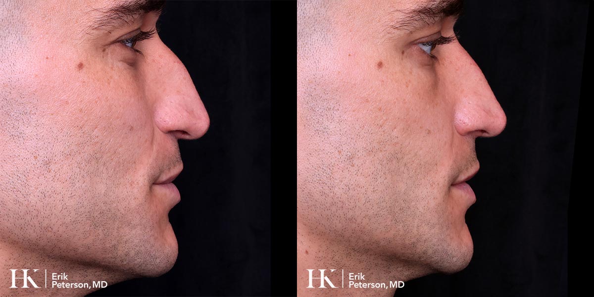 Nose Reshaping (Non-Surgical Rhinoplasty) using Dermal Fillers by Dr. Erik Peterson