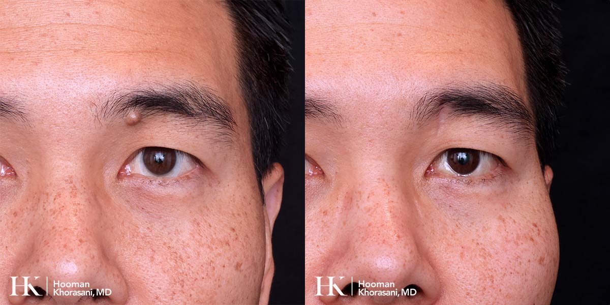 Cosmetic Mole Removal on Eyelid by Excision by Dr. Hooman Khorasani