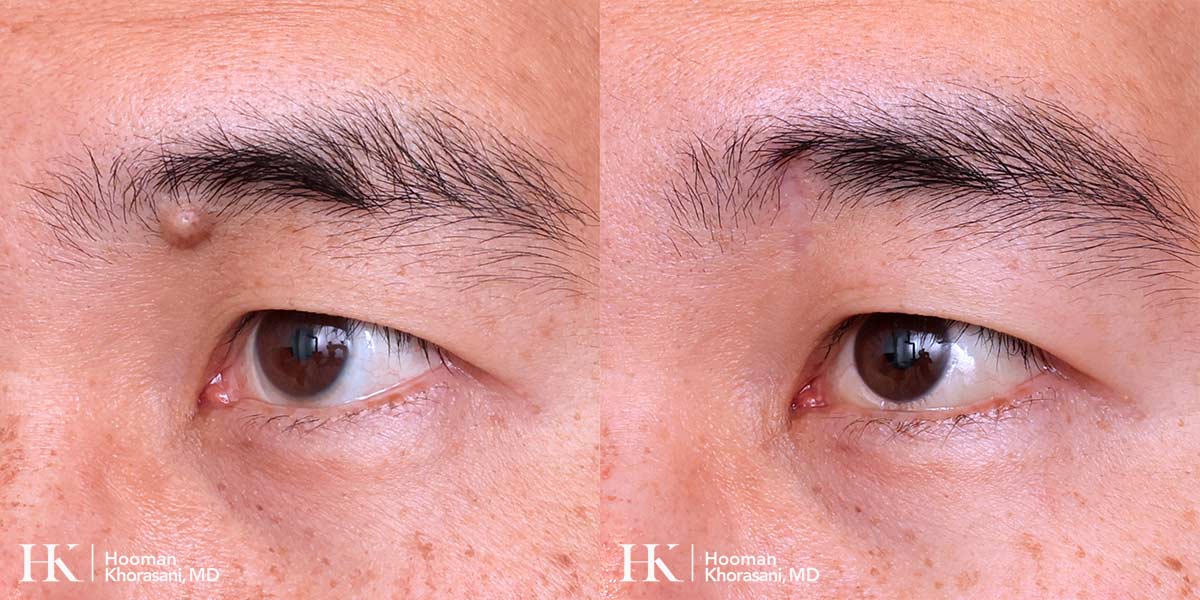 Cosmetic Mole Removal on Eyelid by Excision by Dr. Hooman Khorasani