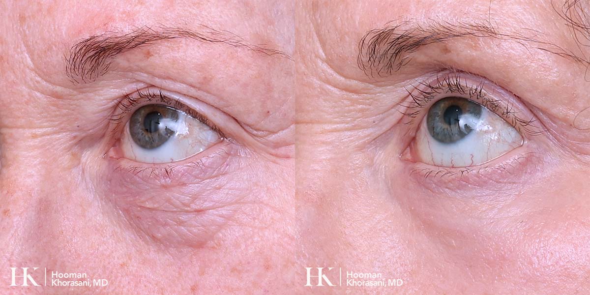 Laser Skin Resurfacing on the Eyes using DeepFX Laser by Dr. Hooman Khorasani