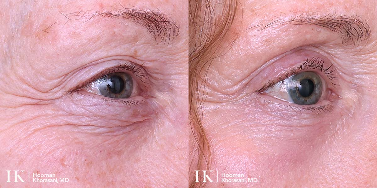 Laser Skin Resurfacing on the Eyes using DeepFX Laser by Dr. Hooman Khorasani