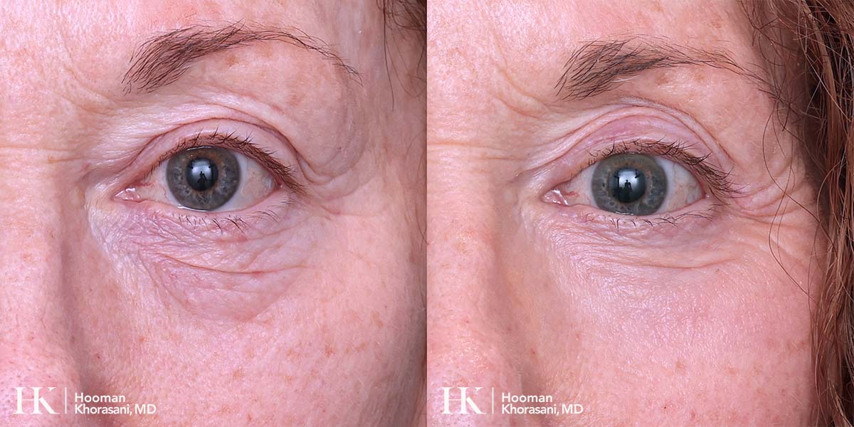 Laser Skin Resurfacing on the Eyes using DeepFX Laser by Dr. Hooman Khorasani