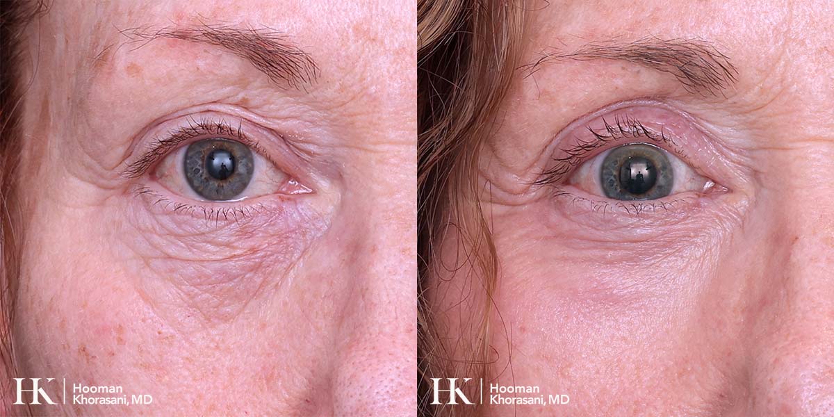 Laser Skin Resurfacing on the Eyes using DeepFX Laser by Dr. Hooman Khorasani