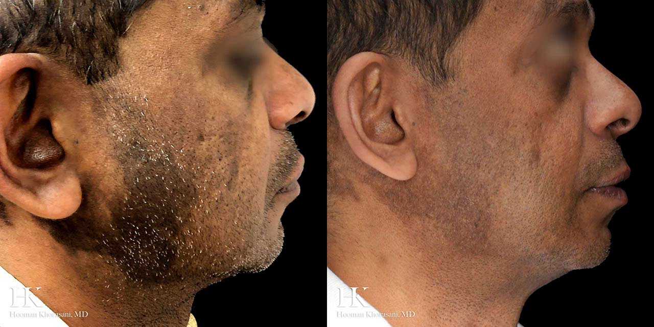 Laser Skin Resurfacing using Fraxel Laser by Dr. Hooman Khorasani