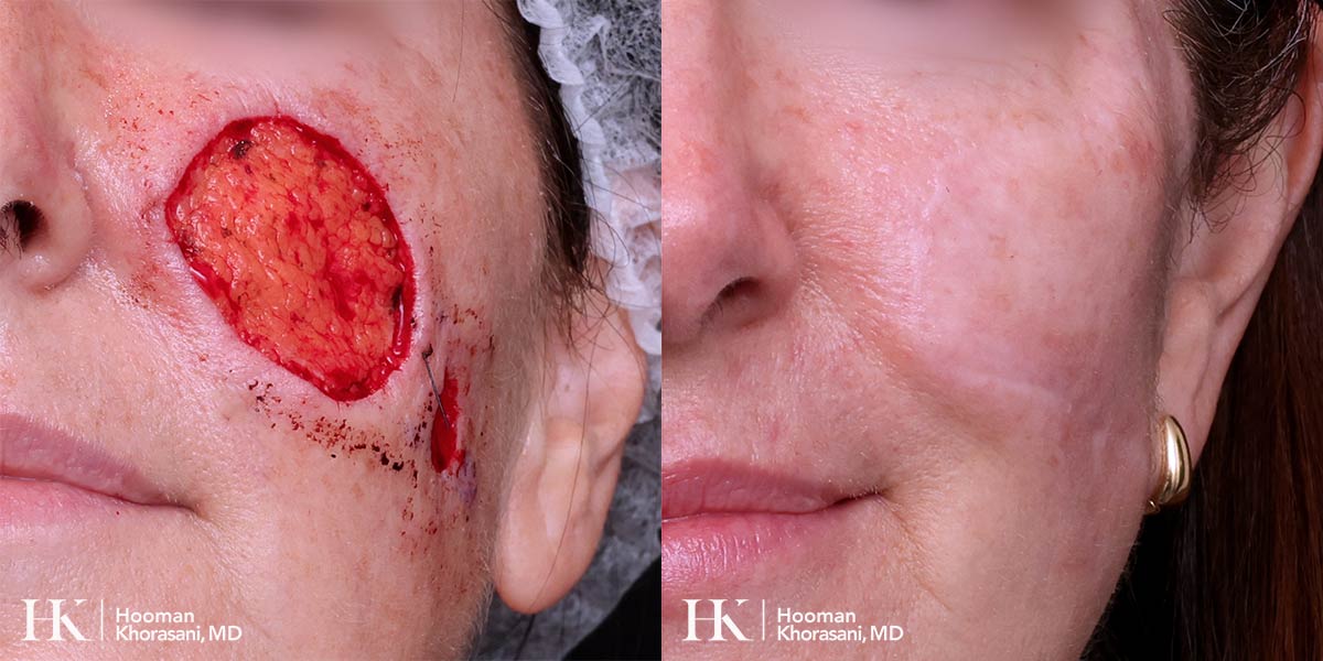 Mohs Micrographic Surgery & Reconstruction of the Cheek by Dr. Hooman Khorasani