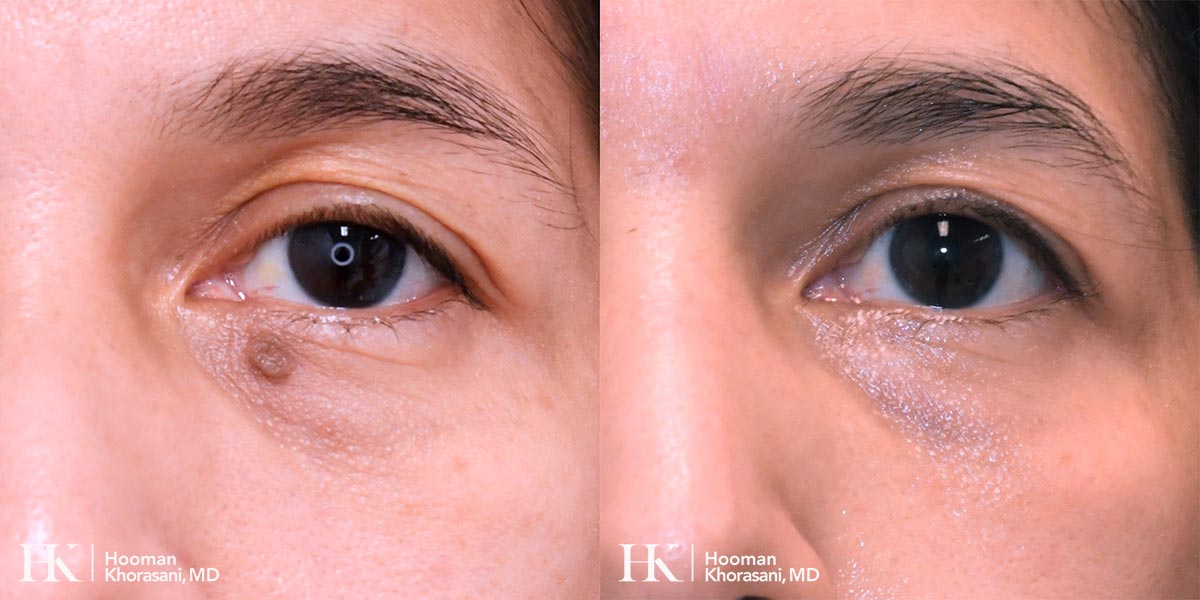 Cosmetic Mole Removal by Dr. Hooman Khorasani
