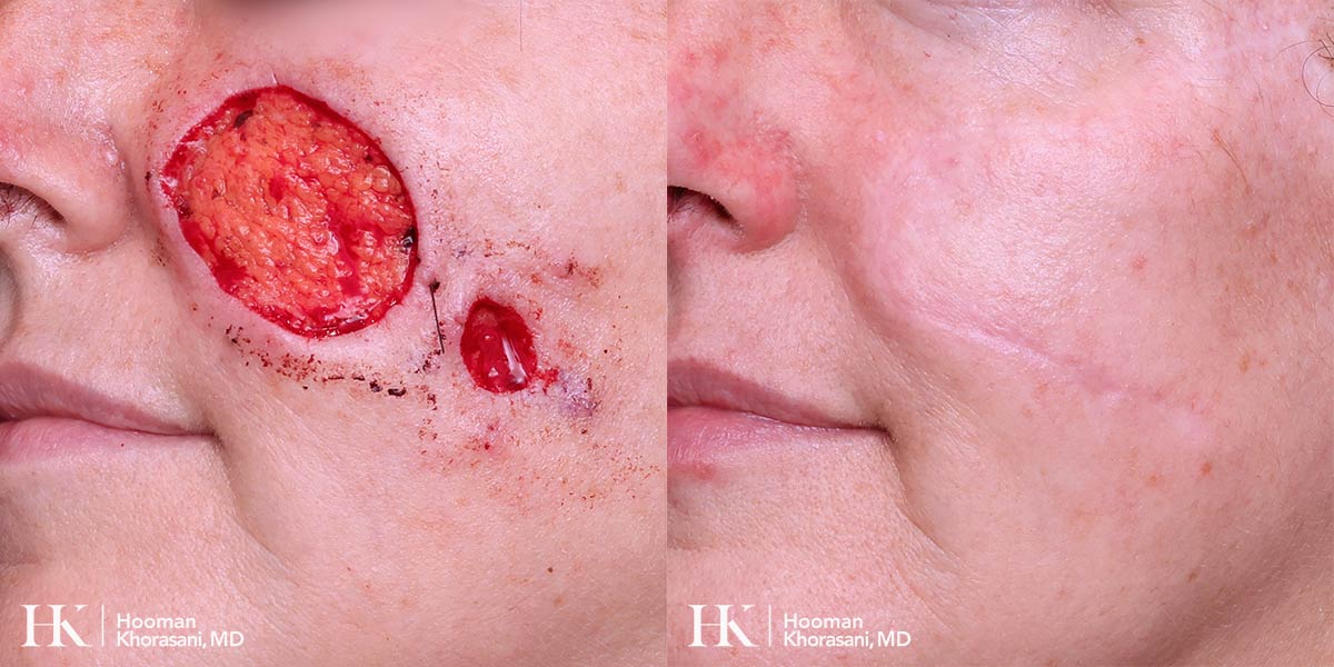 Mohs Micrographic Surgery & Reconstruction of the Cheek by Dr. Hooman Khorasani