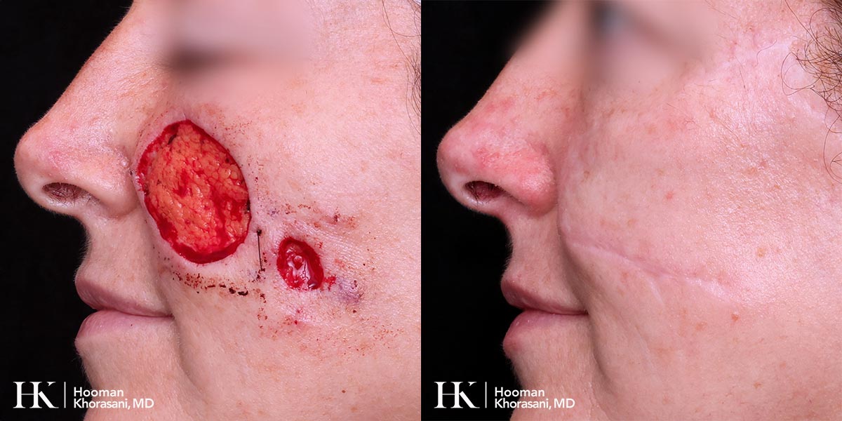 Mohs Micrographic Surgery & Reconstruction of the Cheek by Dr. Hooman Khorasani