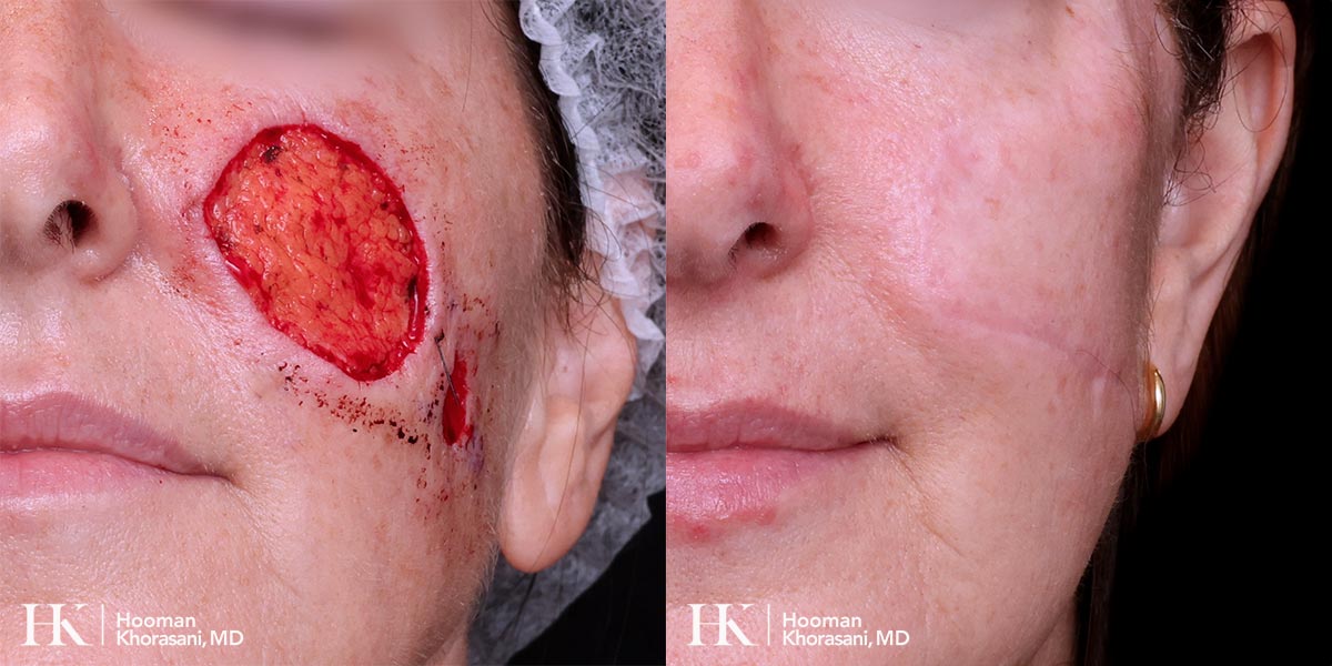 Mohs Micrographic Surgery & Reconstruction of the Cheek by Dr. Hooman Khorasani