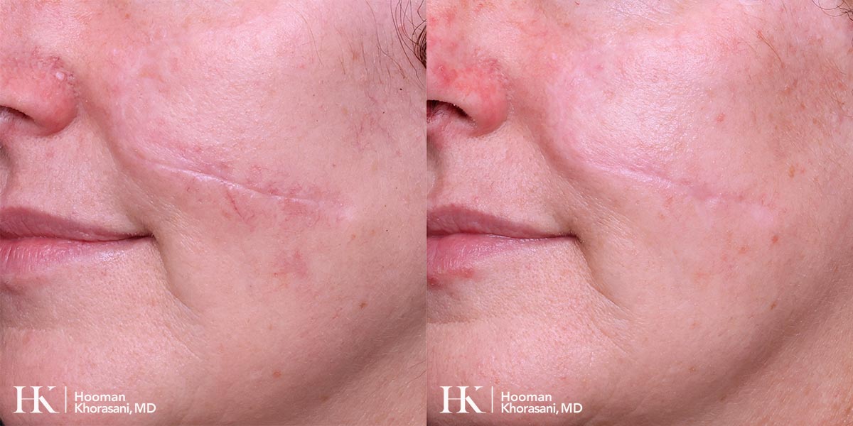 Scar Revision Using Excision and Dermabrasion by Dr. Hooman Khorasani