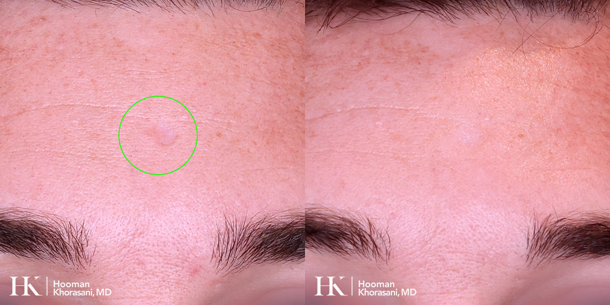 Scar Revision Using Bellafill INjections by Dr. Hooman Khorasani
