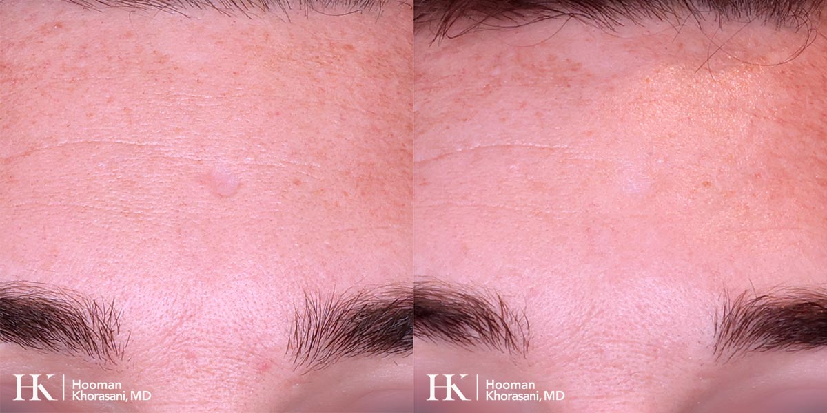 Scar Revision Using Bellafill INjections by Dr. Hooman Khorasani
